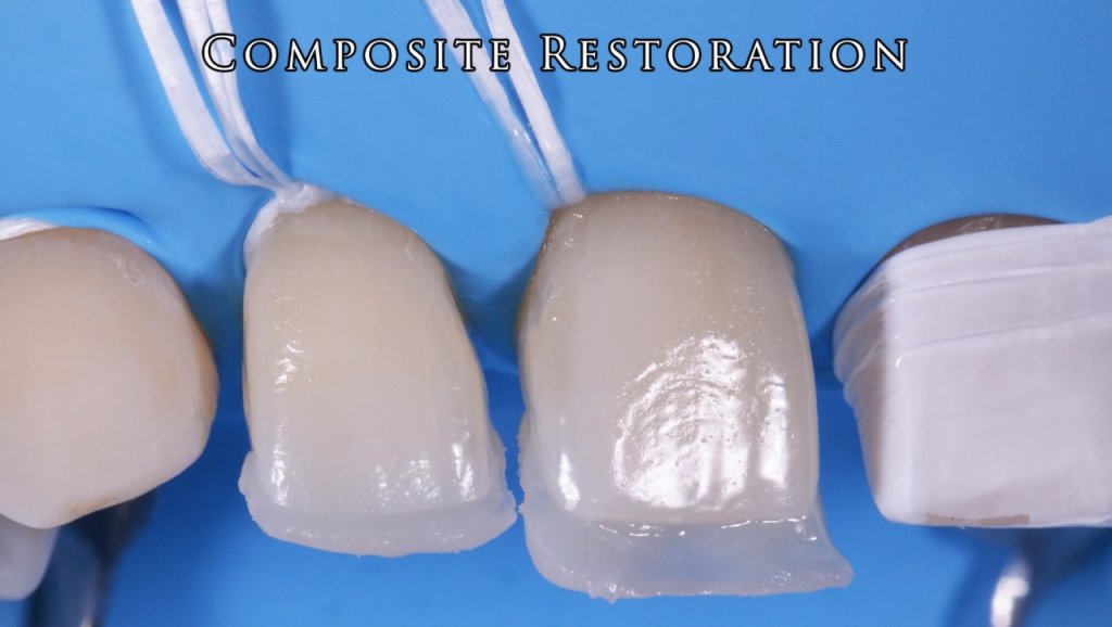 Composite Restoration