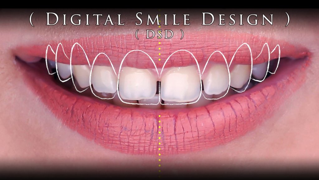 Digital Smile Design