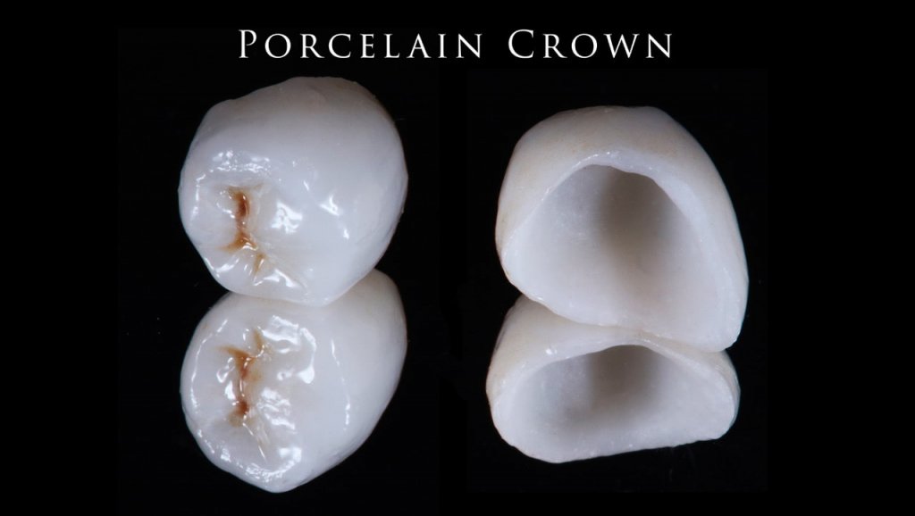 Porcelain Crown
