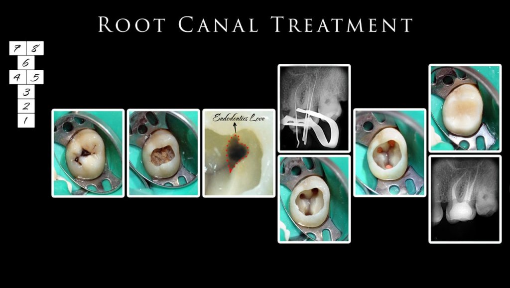 Canal Treatment