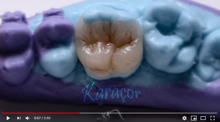 Canal Treatment and Indirect Composite Restoration